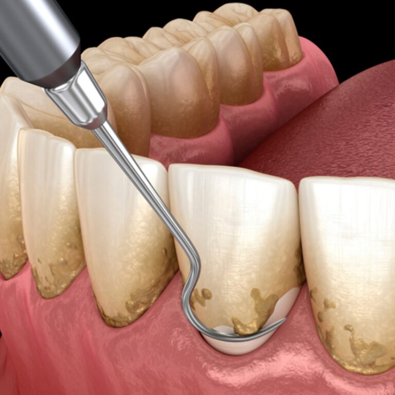 periodoncia_02